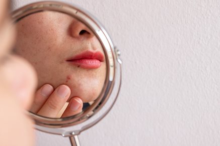 Dr. Badia Featured in Dermatology Times Talking About the Rise of Adult Acne in Women