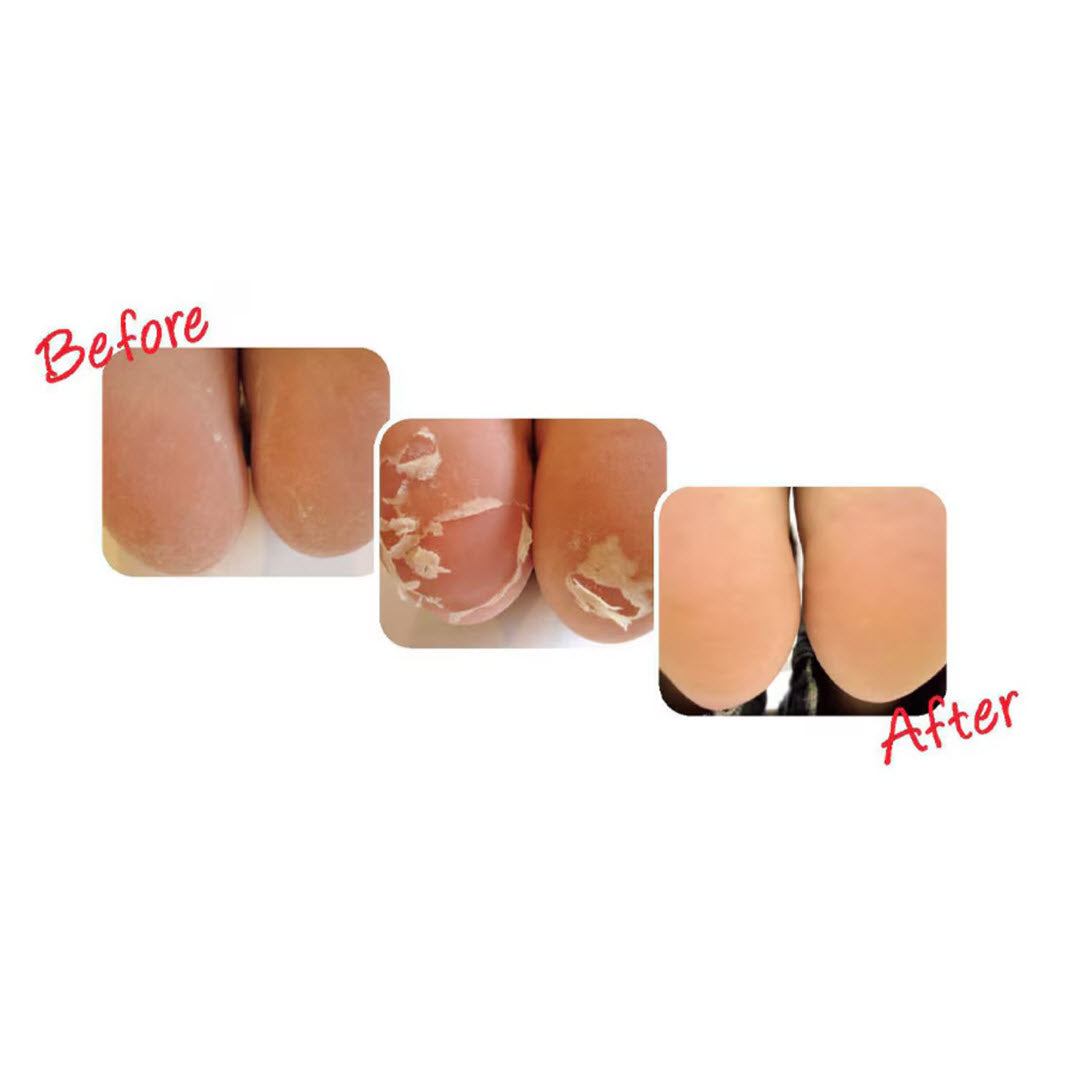 Baby Foot® Exfoliation Foot Peel 1 Treatment
