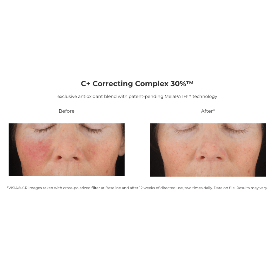 Revision® C+ Correcting Complex 30% 1 FL OZ