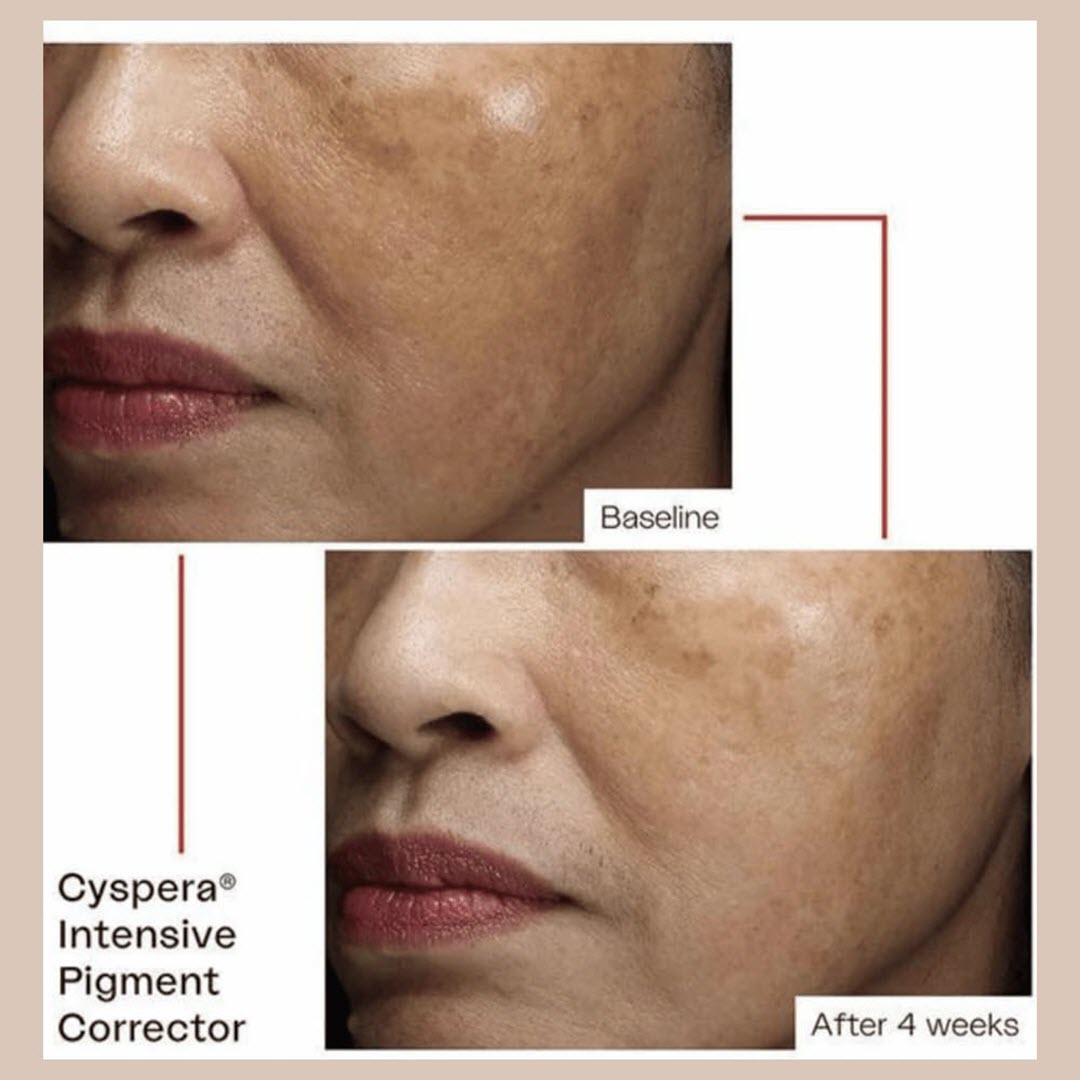 Cyspera® Intensive Pigment Corrector Original Formula 5