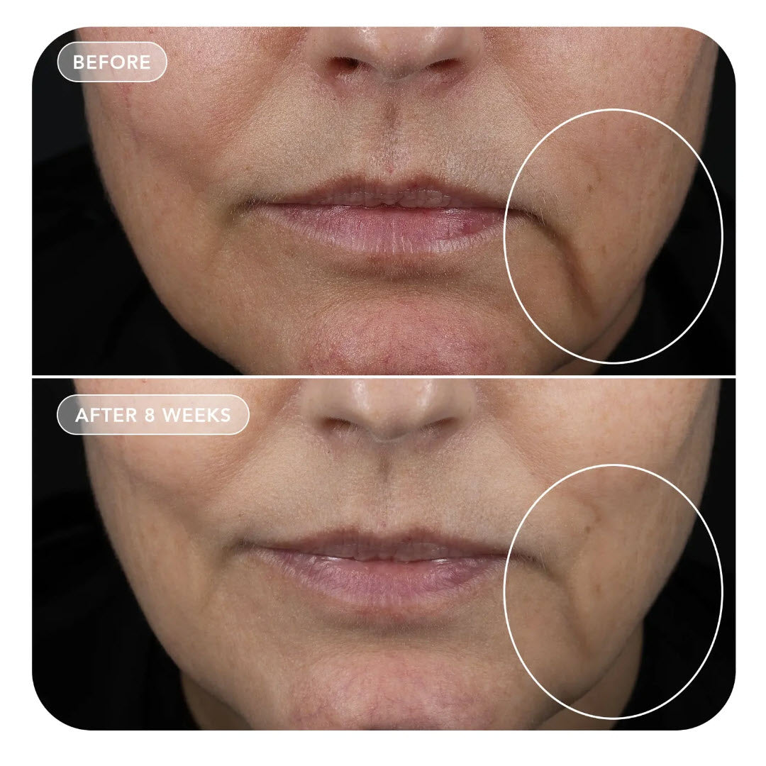 glp 1 dry skin IMAGE VOL.U.LIFT GLP-1 Rebound Complex If your skin started feeling