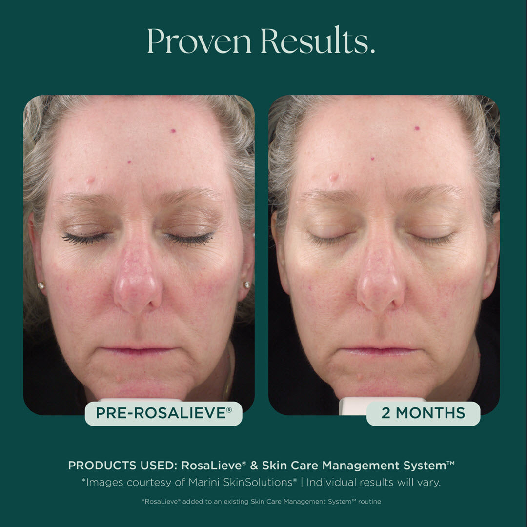 Marini RosaLieve® Redness Reducing Complex | Advanced Dermatology