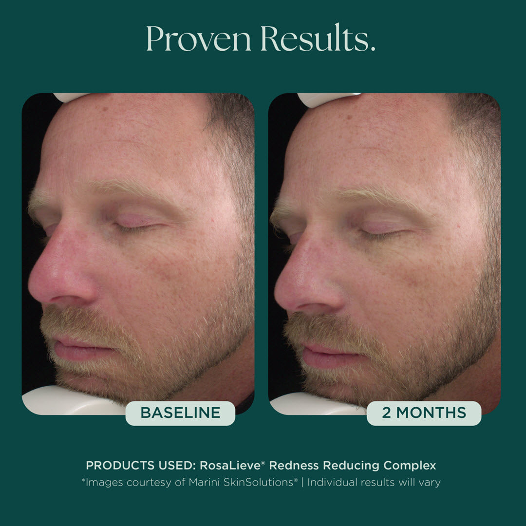 Marini RosaLieve® Redness Reducing Complex | Advanced Dermatology