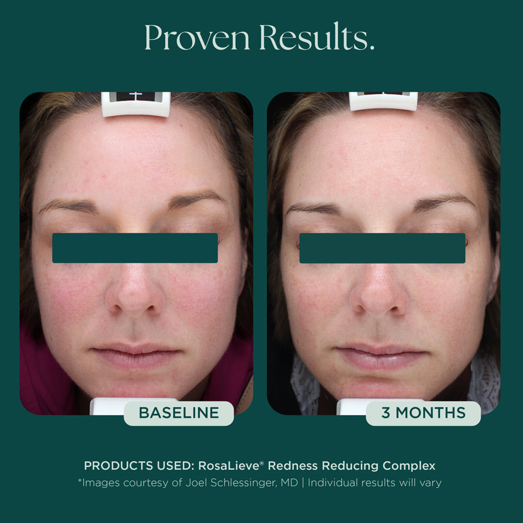 Marini RosaLieve® Redness Reducing Complex | Advanced Dermatology