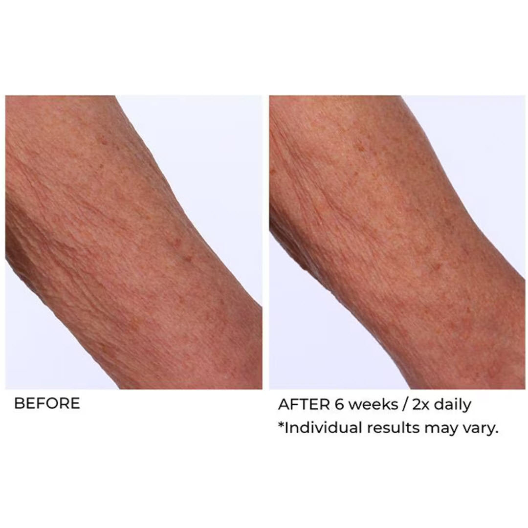 Before and after 6 weeks twice-daily use of NassifMD Crepe Inhibitor Body Butter on crepey arm skin