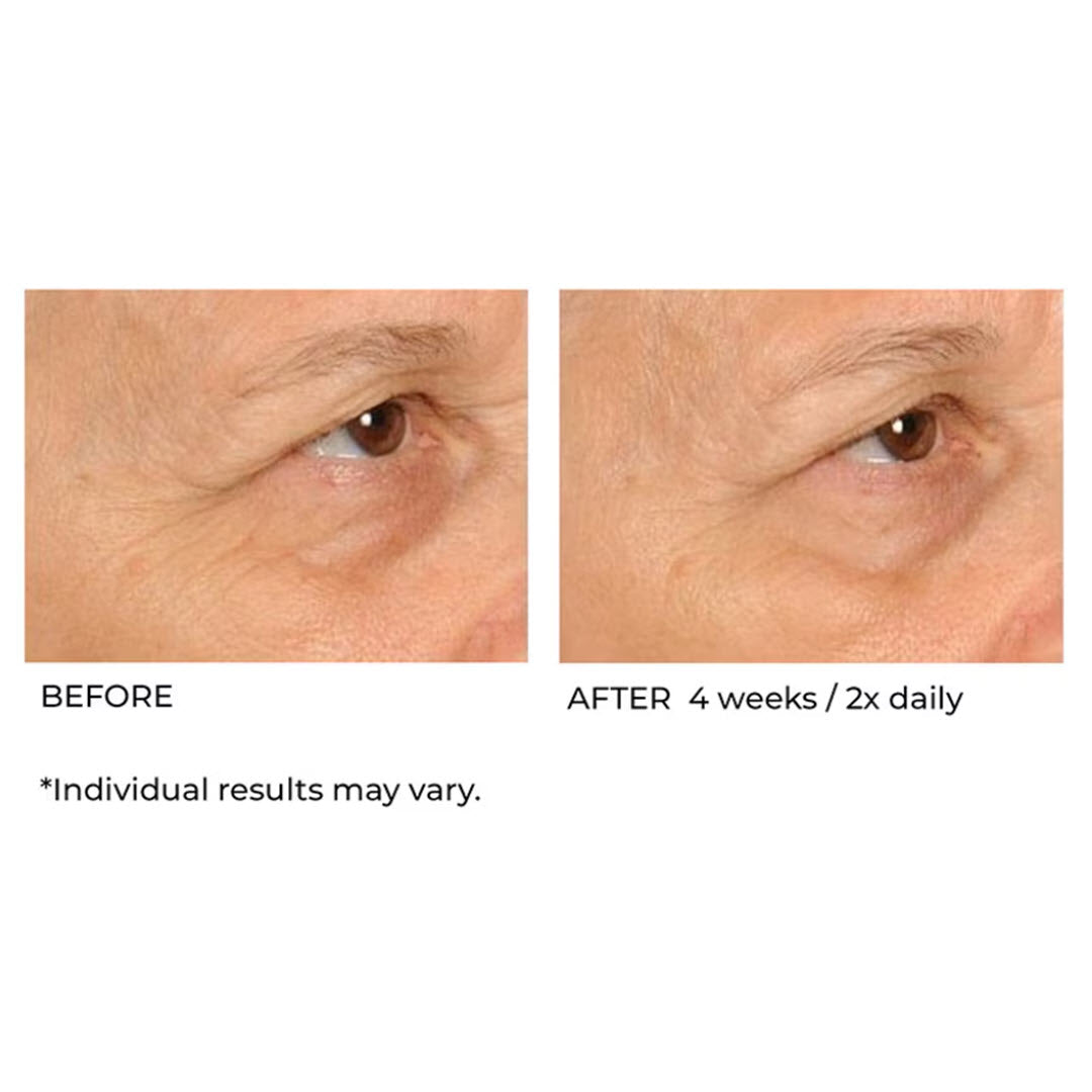 Before and after 4 weeks twice-daily use of NassifMD Hydro-Screen Serum on under-eye fine lines