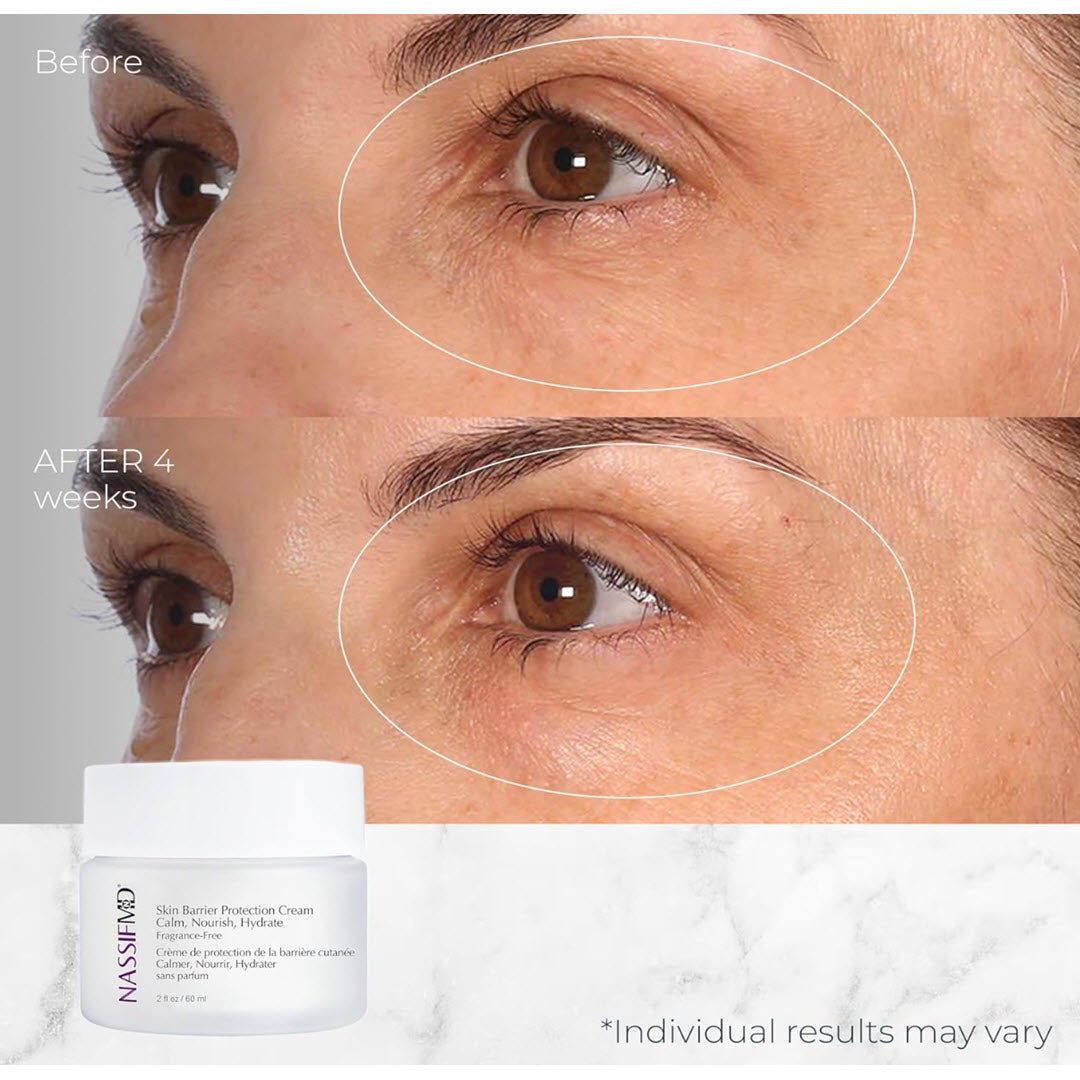 Before and after 4 weeks use of NassifMD Skin Barrier Protection Cream on under-eye fine lines