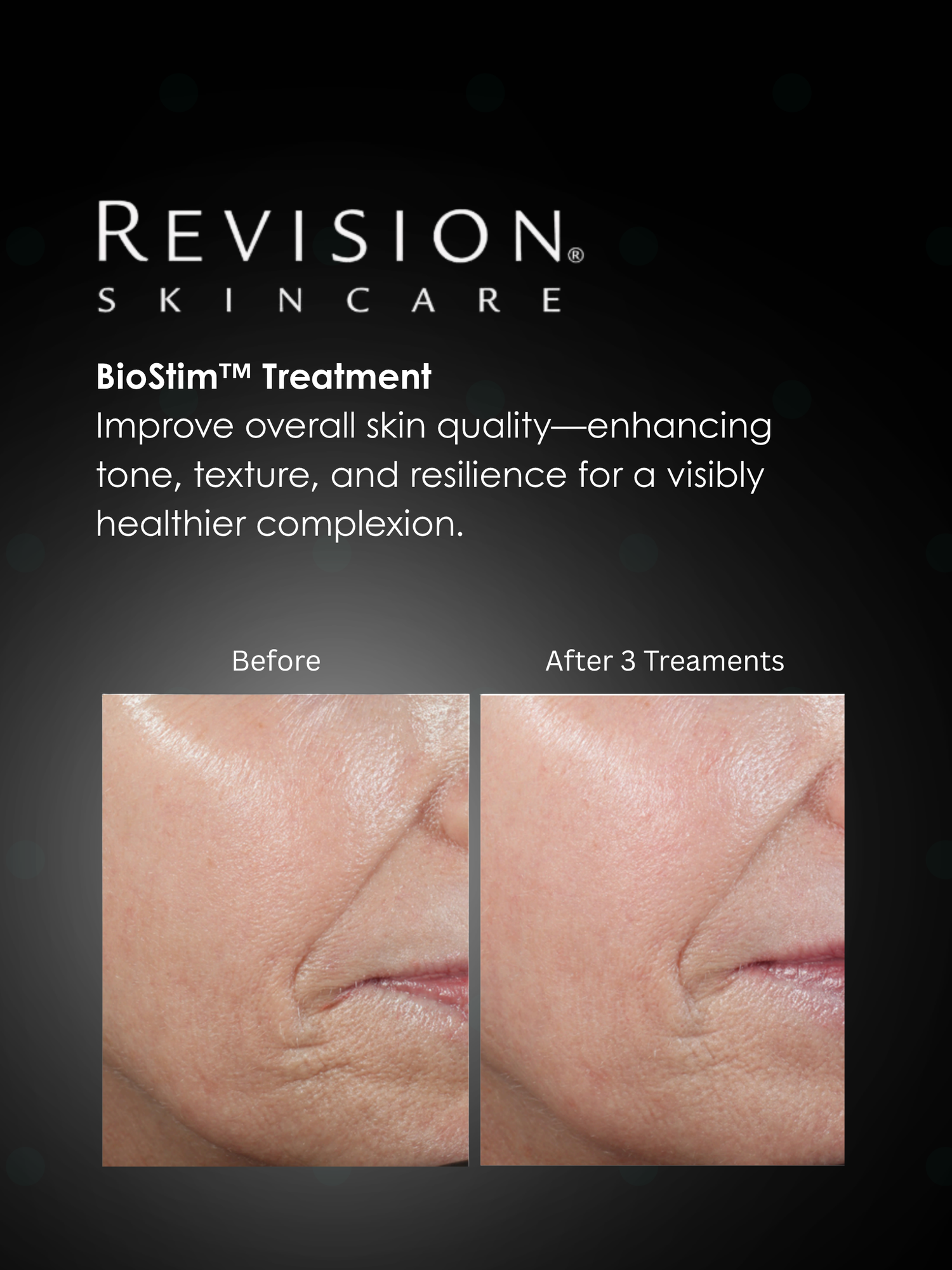 Revision® BioStim Series of 3 + Home Care - (Physical Gift Card)