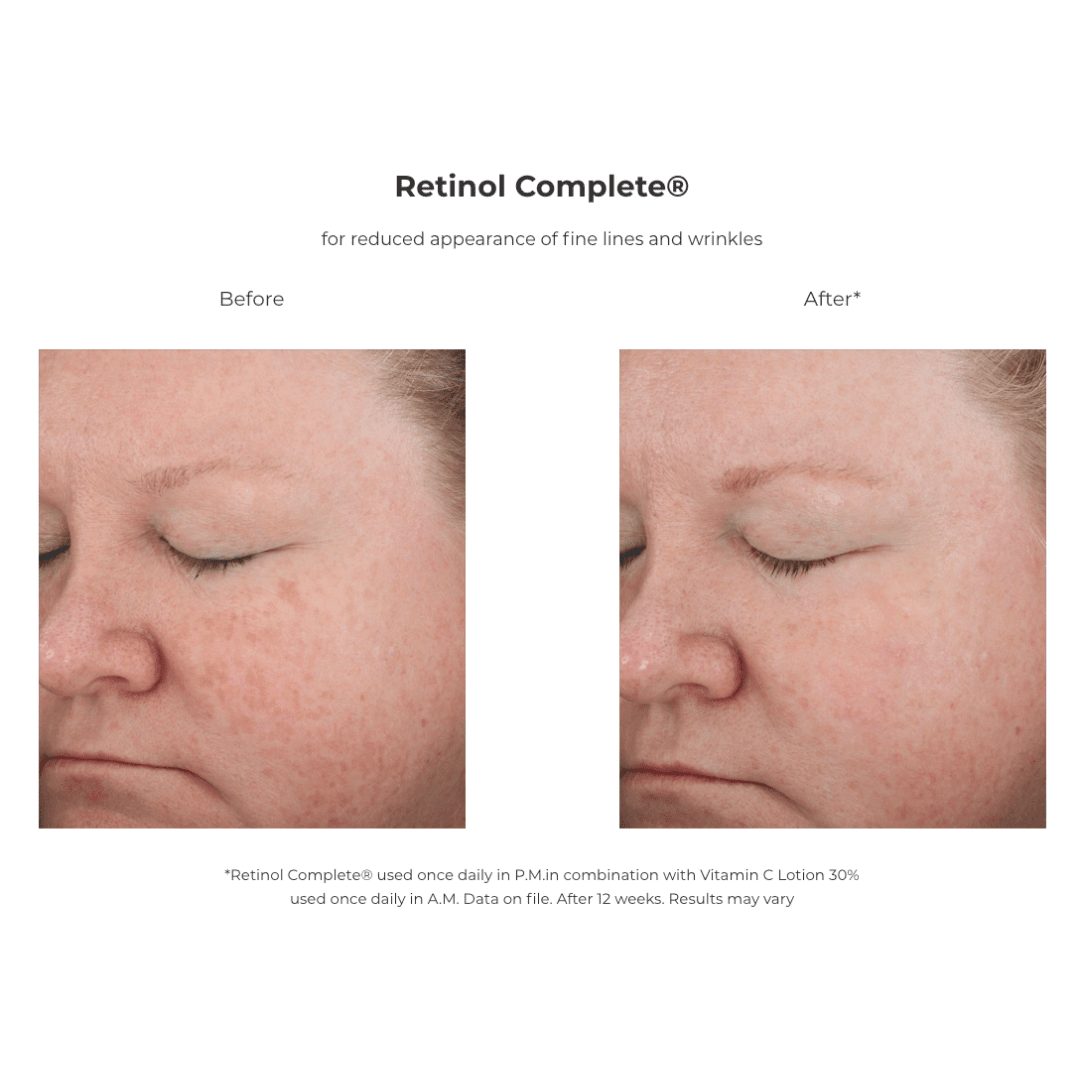 Revision® Retinol Complete® 1.0