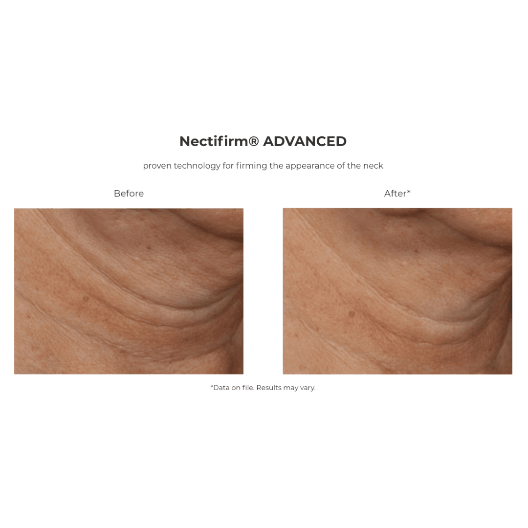 Revision Skincare Nectifirm Advanced before and after showing reduced neck wrinkles