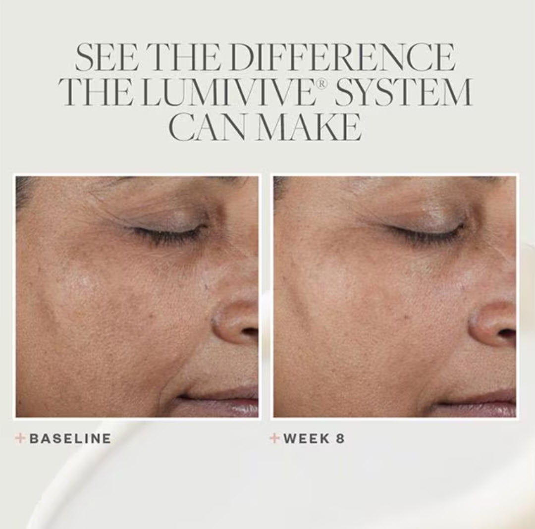 Before and after 8 week clinical results showing visibly brighter, more even-toned skin using the SkinMedica LUMIVIVE System