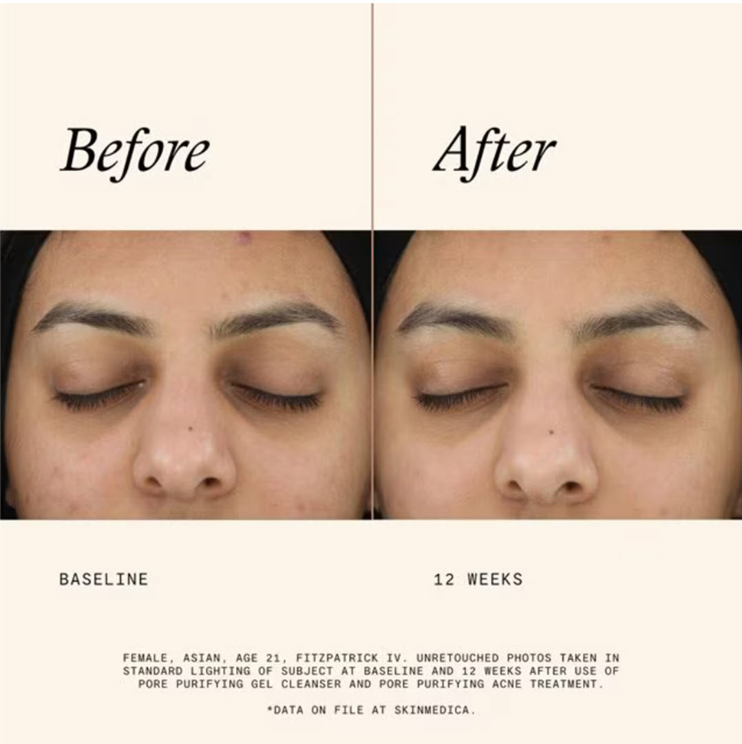 Before and after 12 week clinical results showing clearer skin and reduced congestion using SkinMedica Pore Purifying Gel Cleanser and Pore Purifying Acne Treatment
