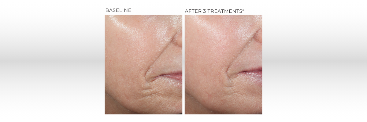Revision Skincare® D·E·J BioStim™ Treatment Package Gift Card