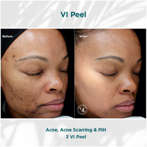 Acne, Scarring _ PIH_02