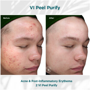 Acne _ PIE