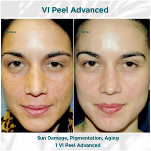 Sun Damage, Pigmentation _ Aging