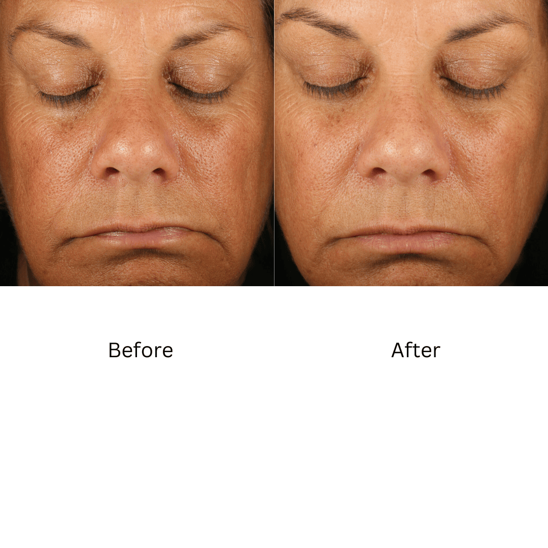 ZO® Retinol Skin Brightener 1% - Advanced Dermatology and